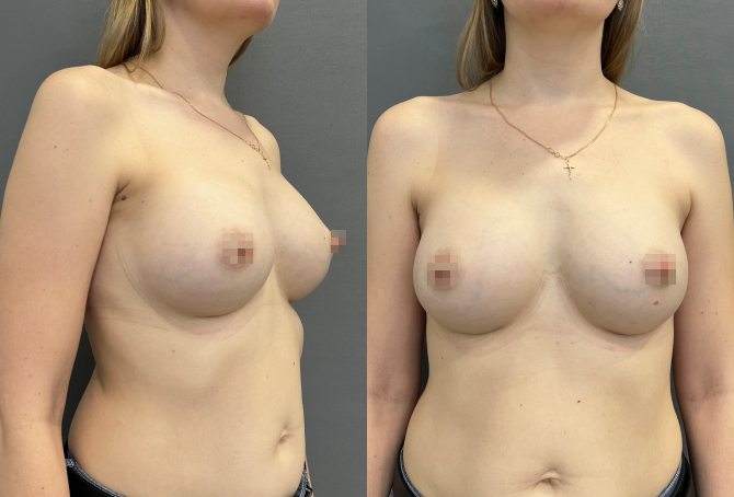 Увеличение груди - фото 2